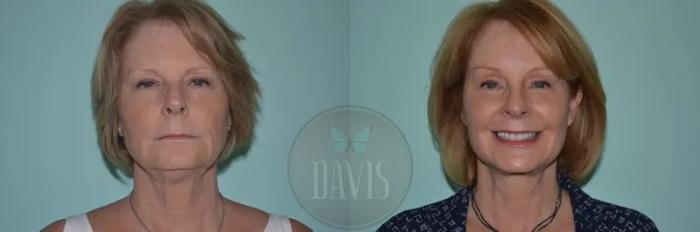 Before & After Facelift Case 1133 View 3 View in Tampa, FL