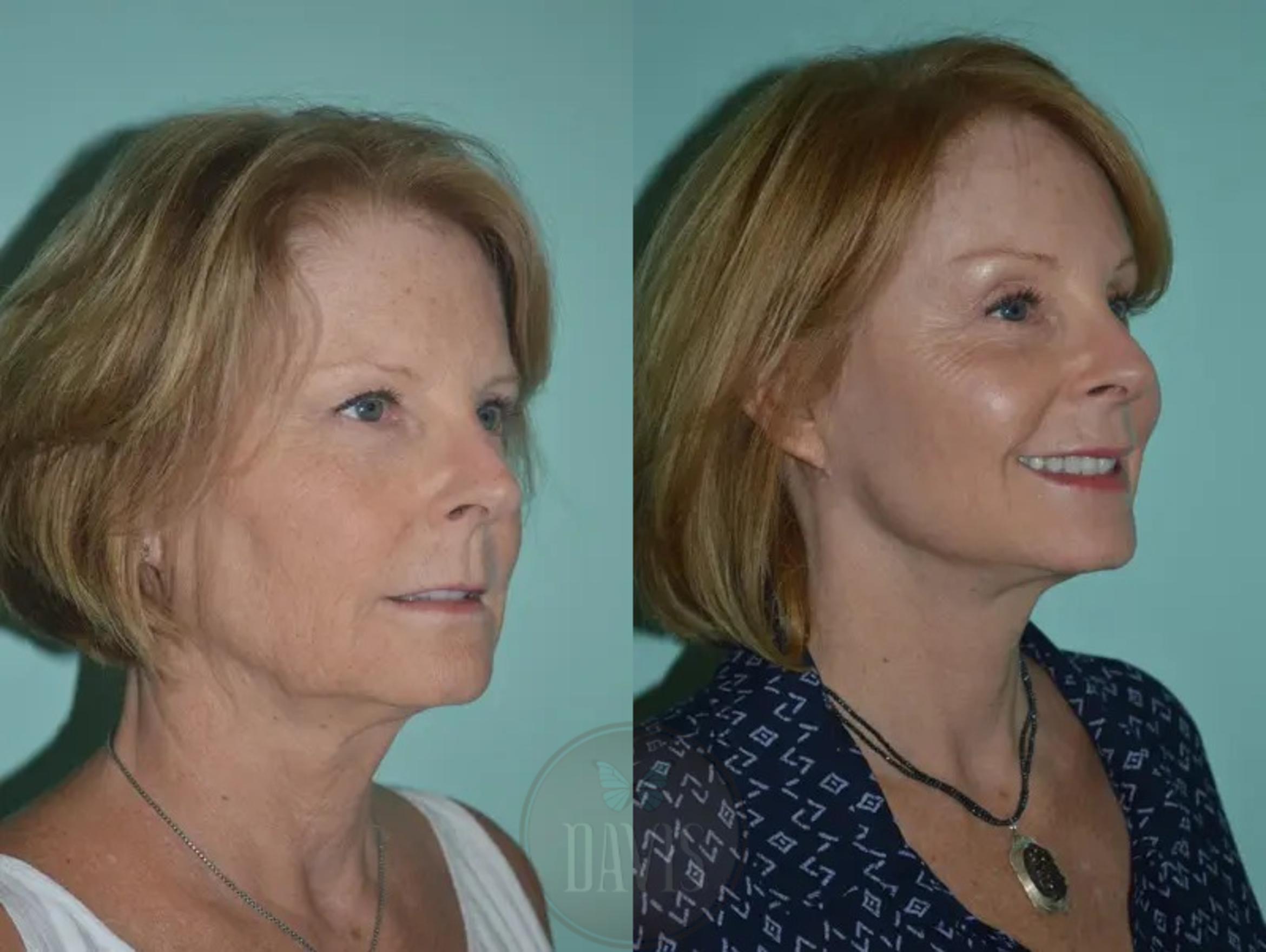 Before & After Facelift Case 1133 View 4 View in Tampa, FL