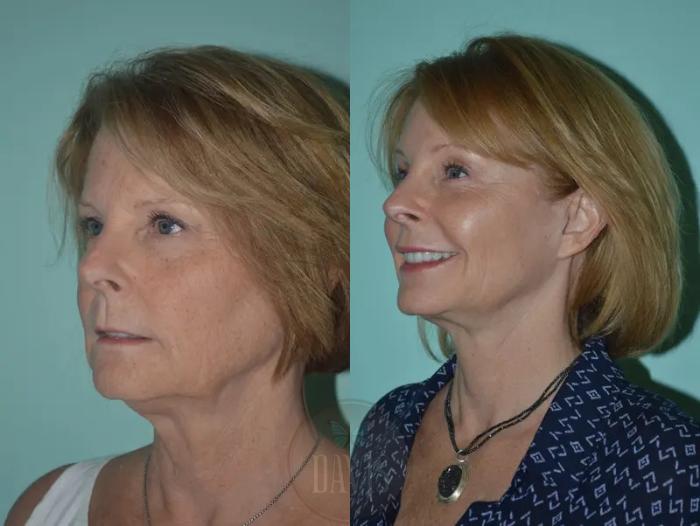 Before & After Facelift Case 1133 View 5 View in Tampa, FL