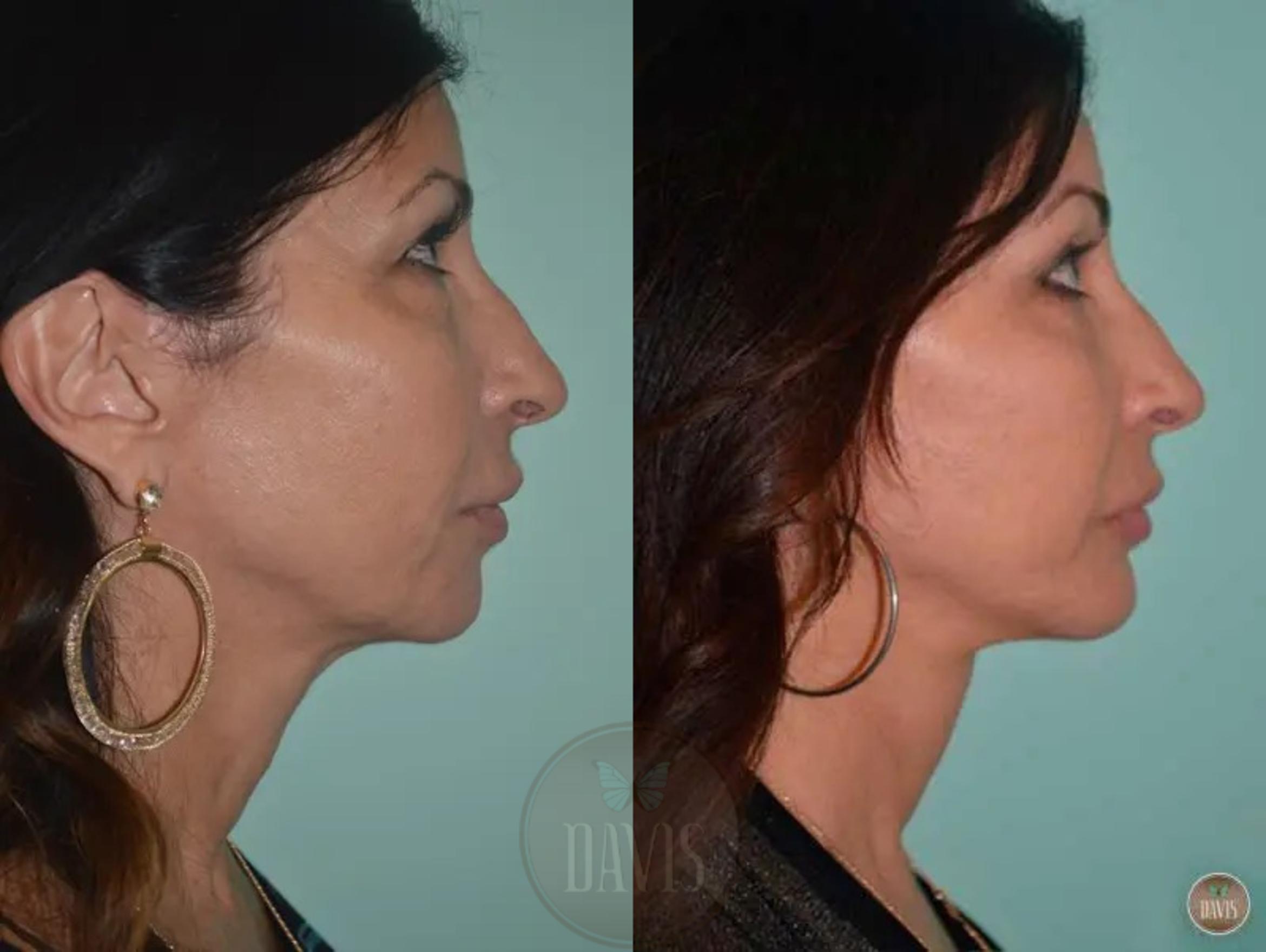 Before & After Facelift Case 1134 View 1 View in Tampa, FL