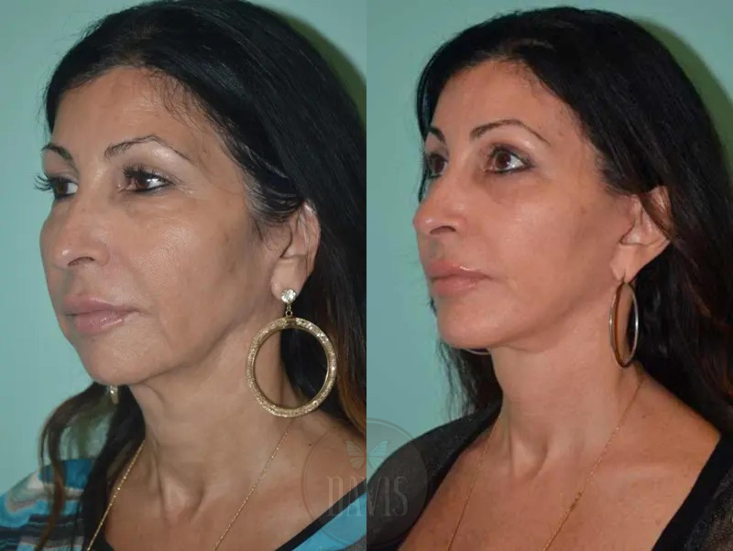 Before & After Facelift Case 1134 View 2 View in Tampa, FL