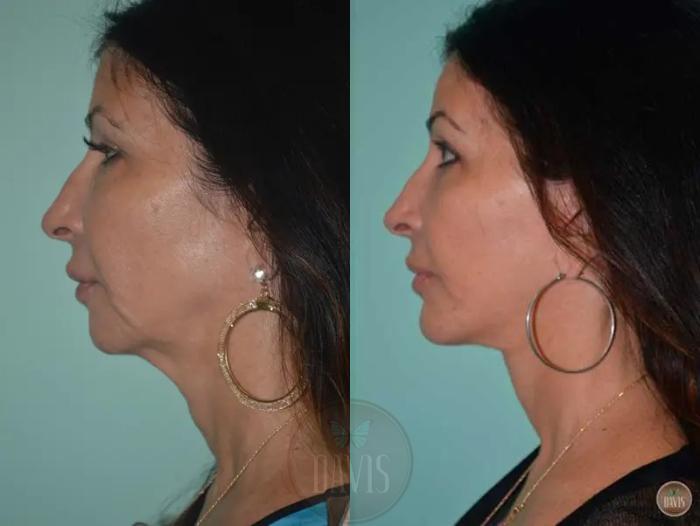 Before & After Facelift Case 1134 View 3 View in Tampa, FL