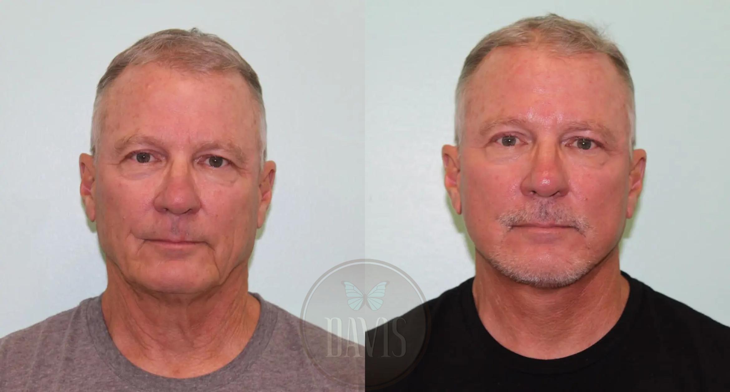 Before & After Facelift Case 1135 View 1 View in Tampa, FL