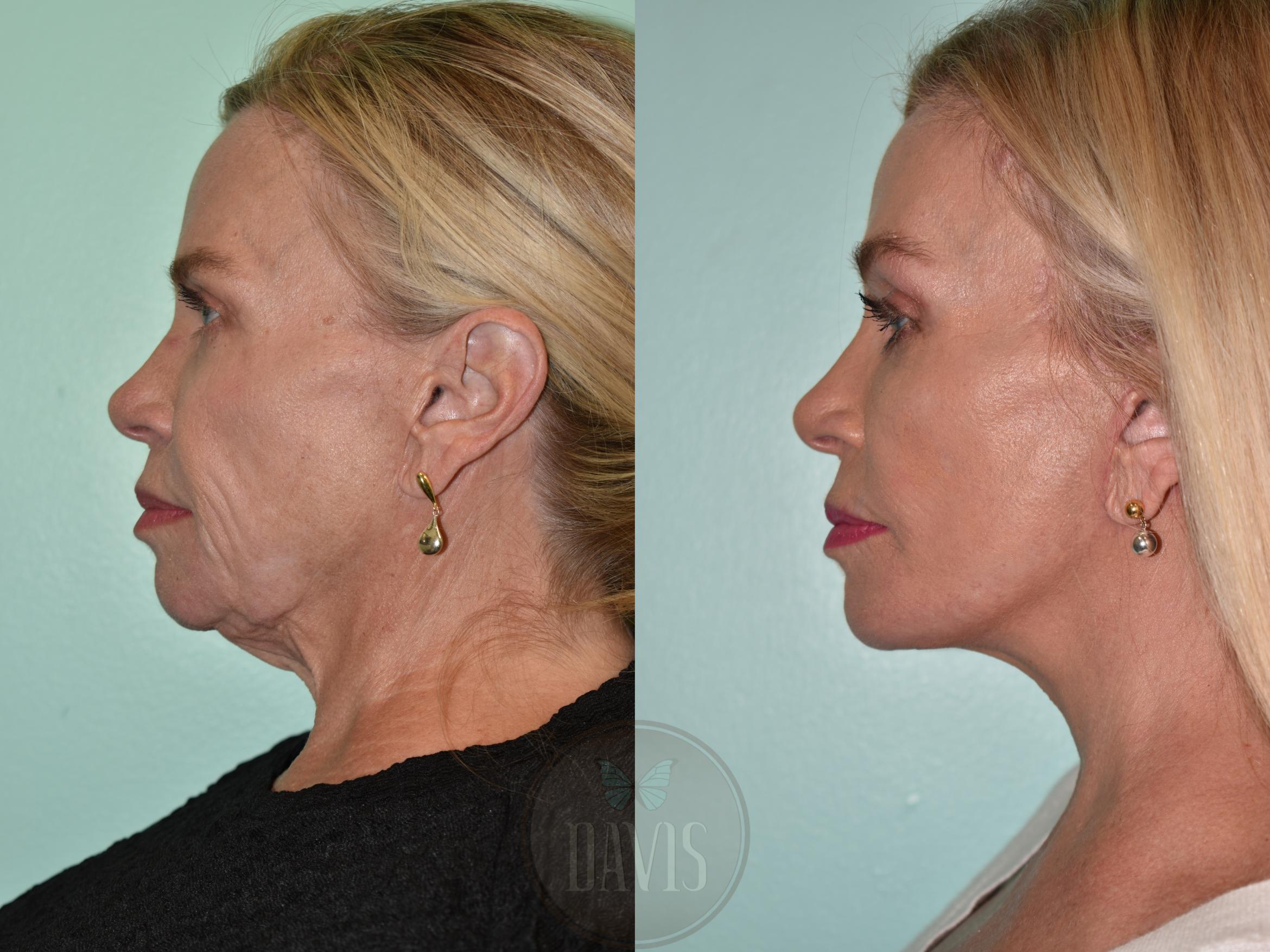 Before & After Facelift Case 1158 Front View in Tampa, FL