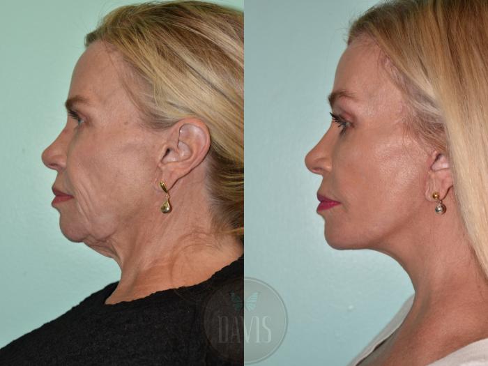 Before & After Facelift Case 1158 Front View in Tampa, FL