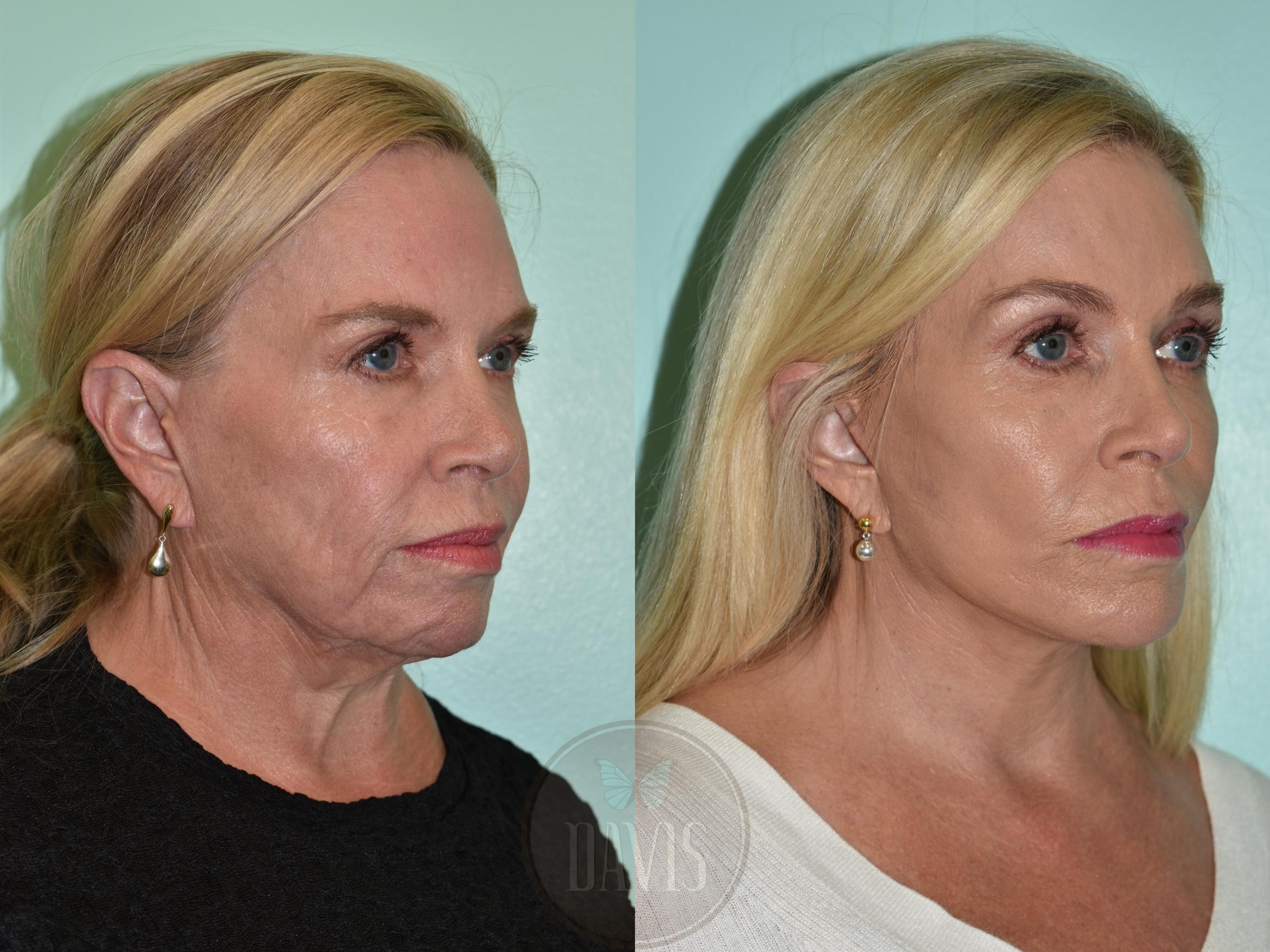 Before & After Facelift Case 1158 Left Oblique View in Tampa, FL