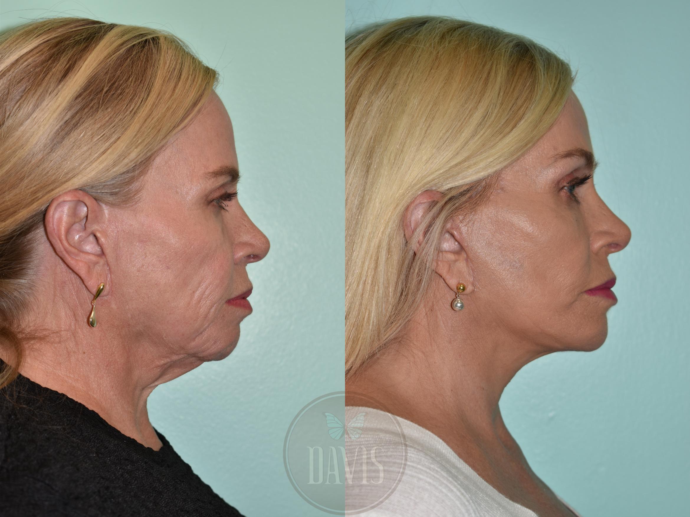 Before & After Facelift Case 1158 Left Side View in Tampa, FL