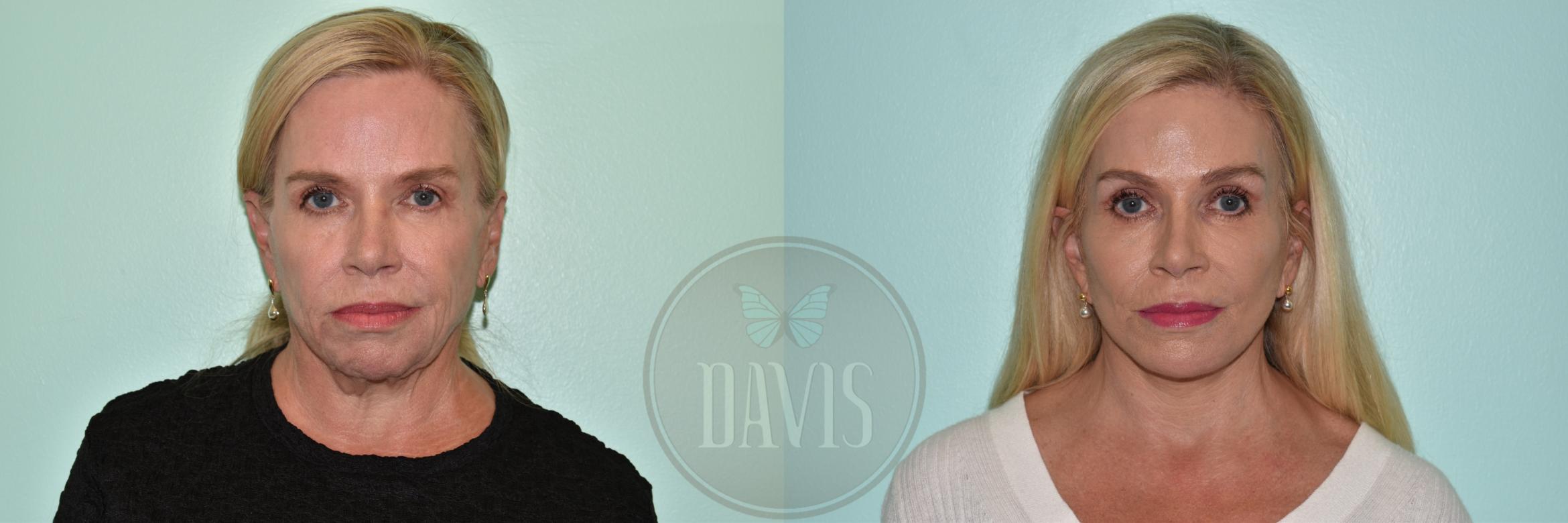 Before & After Facelift Case 1158 Right Side View in Tampa, FL