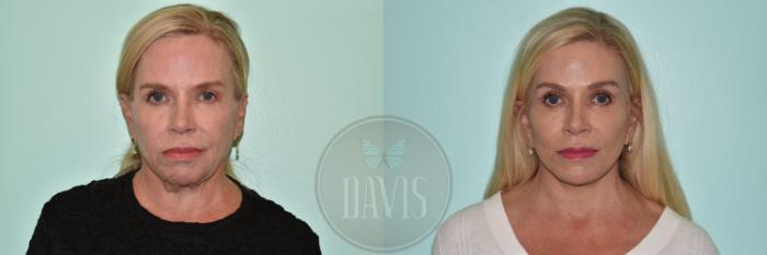 Before & After Facelift Case 1158 Right Side View in Tampa, FL