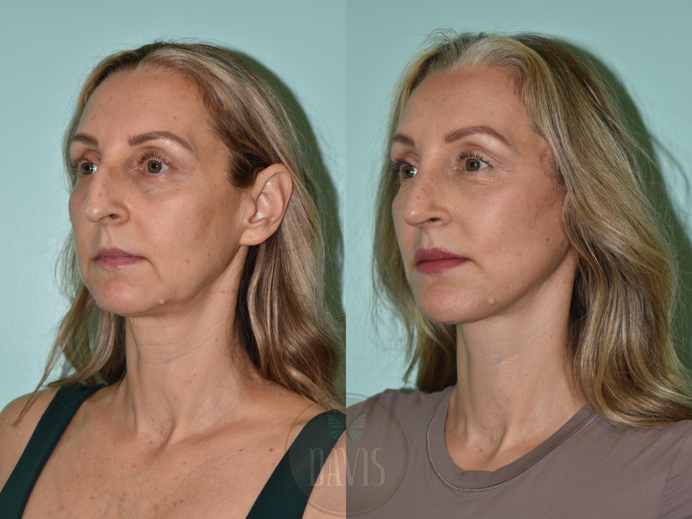 Before & After Facelift Case 1172 Front View in Tampa, FL