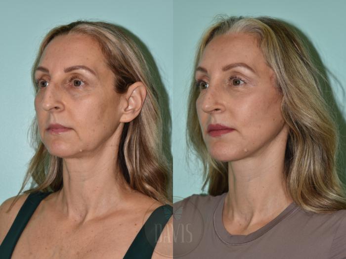 Before & After Facelift Case 1172 Front View in Tampa, FL