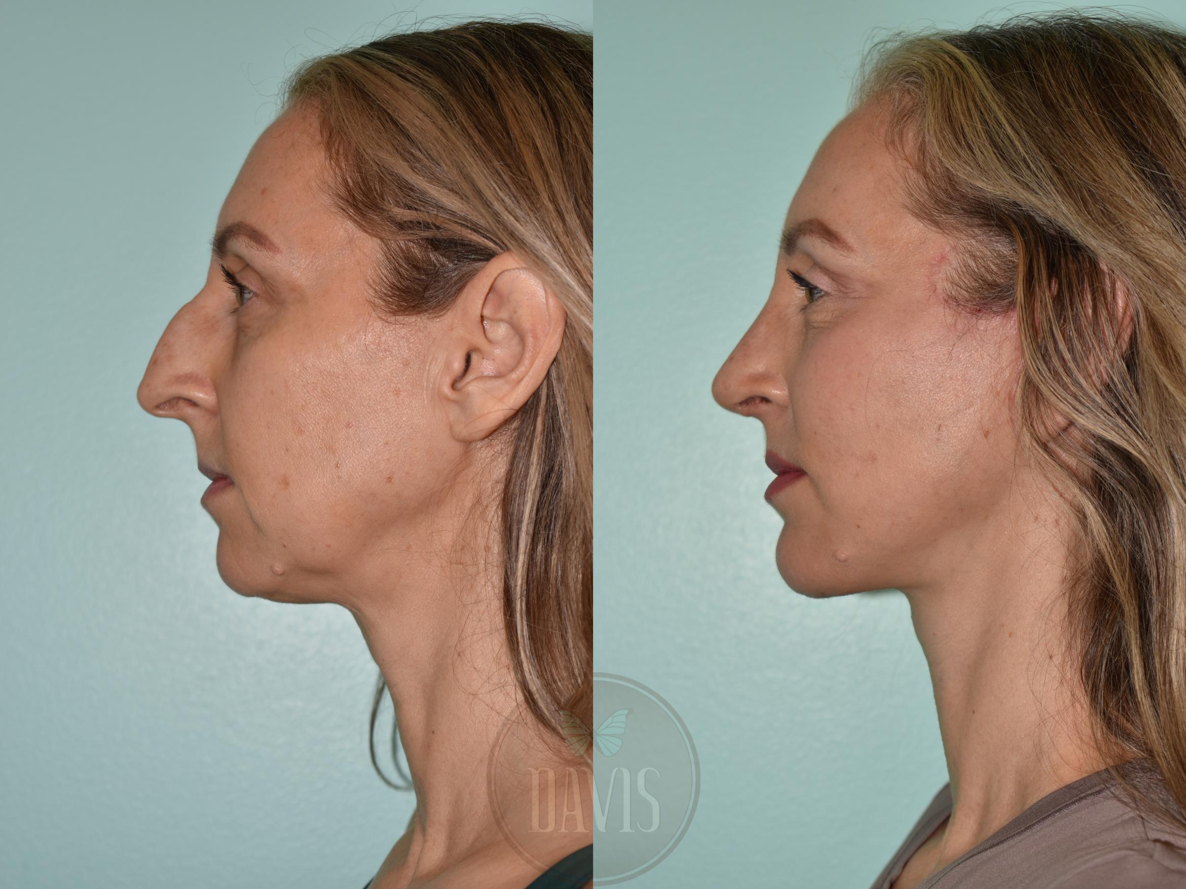 Before & After Facelift Case 1172 Left Oblique View in Tampa, FL