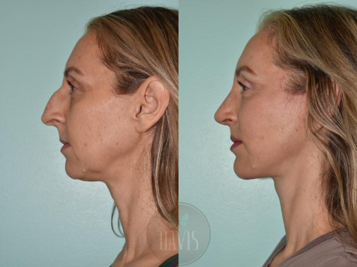 Before & After Facelift Case 1172 Left Oblique View in Tampa, FL