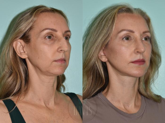Before & After Facelift Case 1172 Left Side View in Tampa, FL