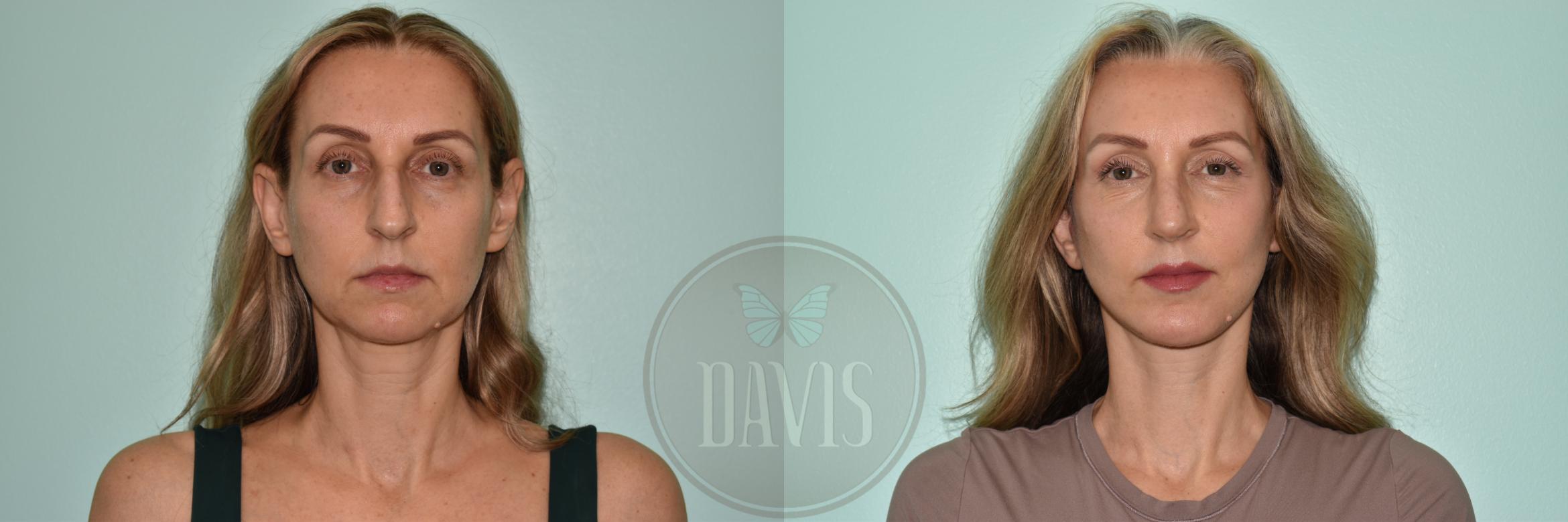 Before & After Facelift Case 1172 Right Side View in Tampa, FL