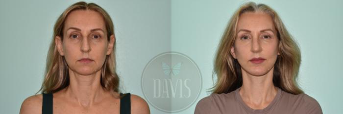 Before & After Facelift Case 1172 Right Side View in Tampa, FL