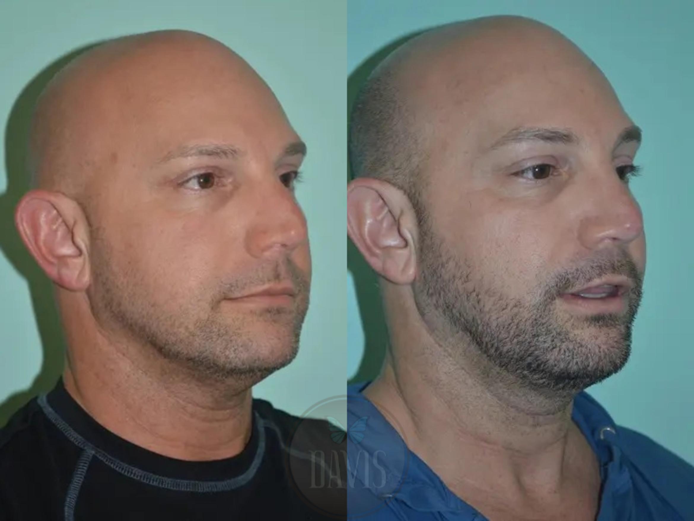 Before & After Facial Liposuction Case 1121 View 1 View in Tampa, FL