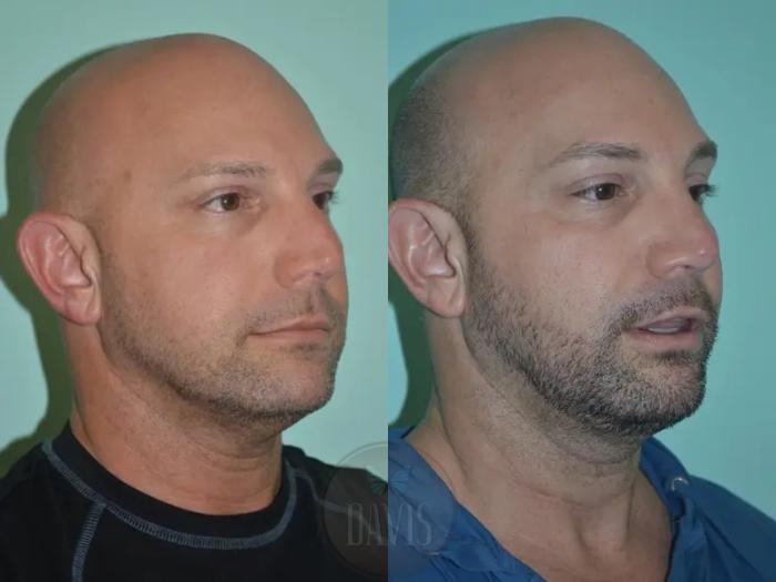 Before & After Facial Liposuction Case 1121 View 1 View in Tampa, FL