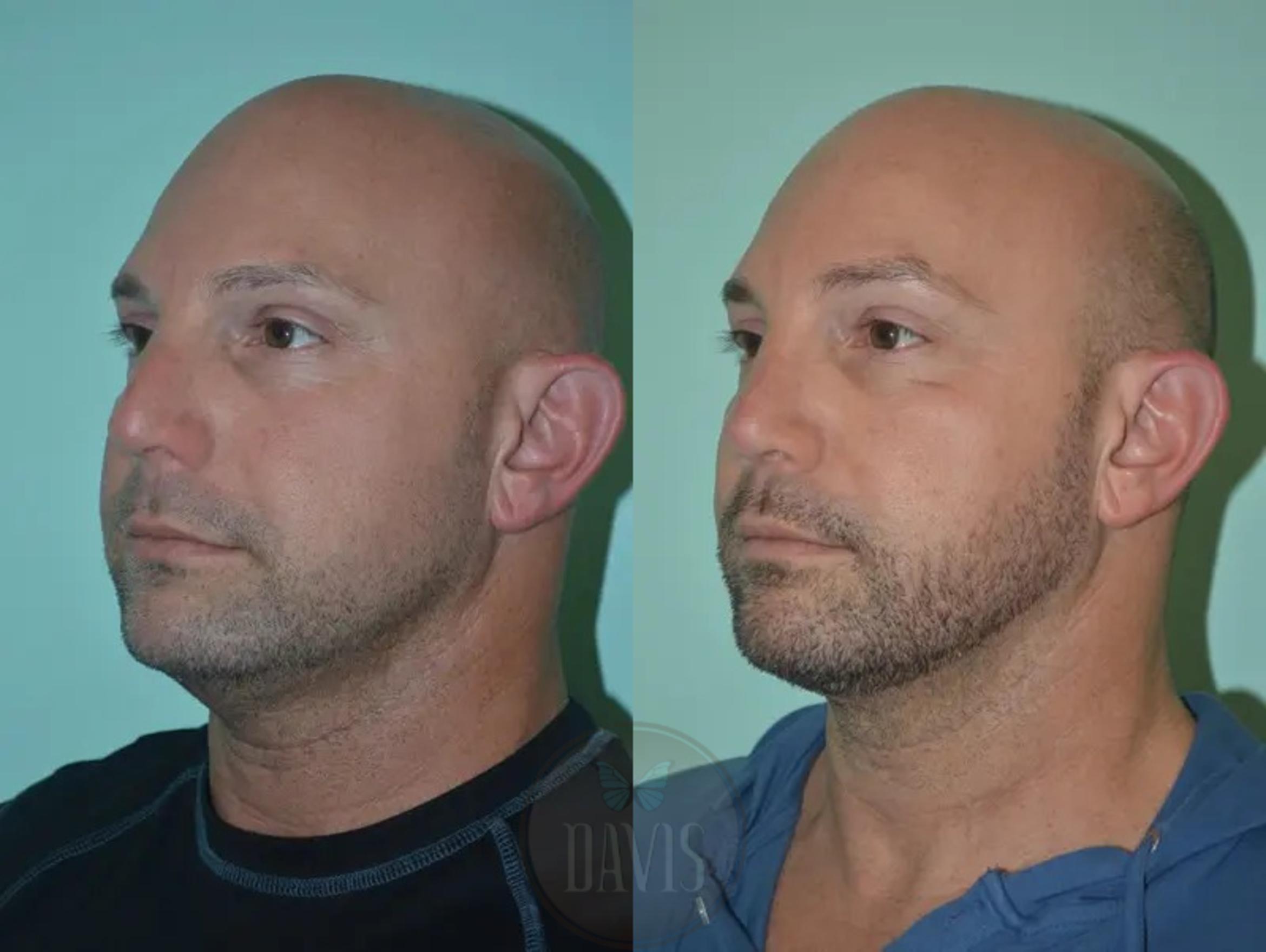 Before & After Facial Liposuction Case 1121 View 2 View in Tampa, FL