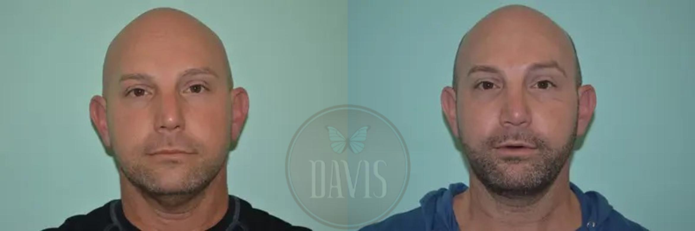 Before & After Facial Liposuction Case 1121 View 3 View in Tampa, FL