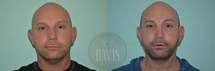 Before & After Facial Liposuction Case 1121 View 3 View in Tampa, FL