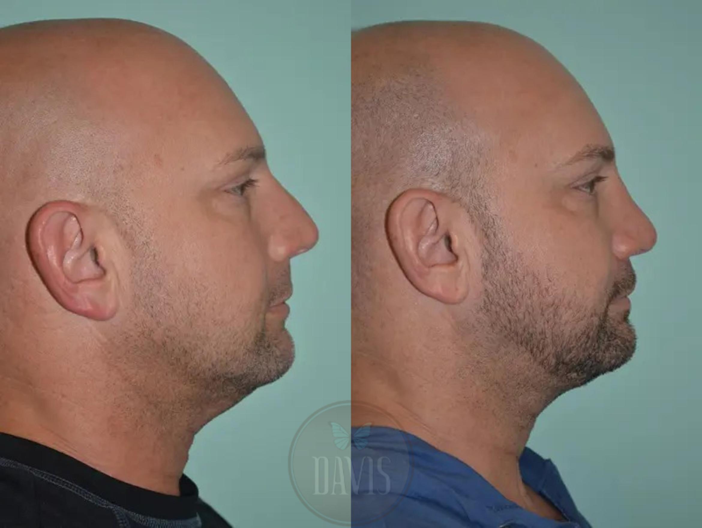 Before & After Facial Liposuction Case 1121 View 4 View in Tampa, FL