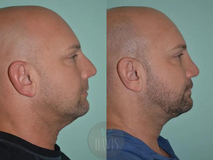 Before & After Facial Liposuction Case 1121 View 4 View in Tampa, FL
