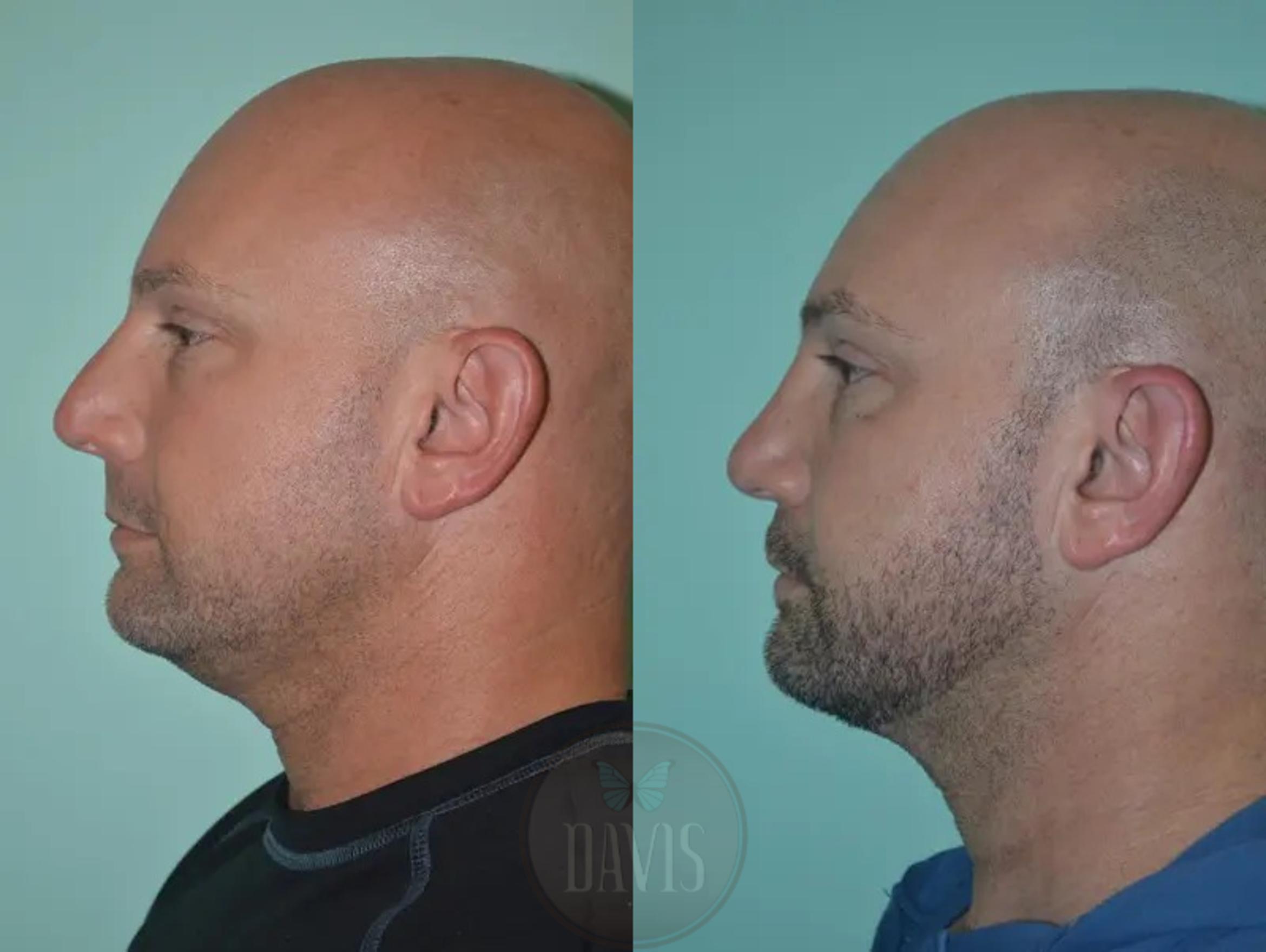 Before & After Facial Liposuction Case 1121 View 5 View in Tampa, FL