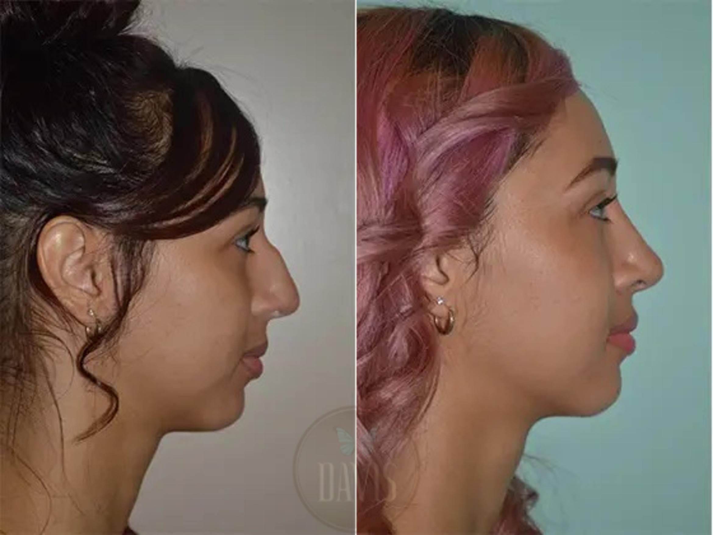 Before & After Female Rhinoplasty Case 1052 View 1 View in Tampa, FL