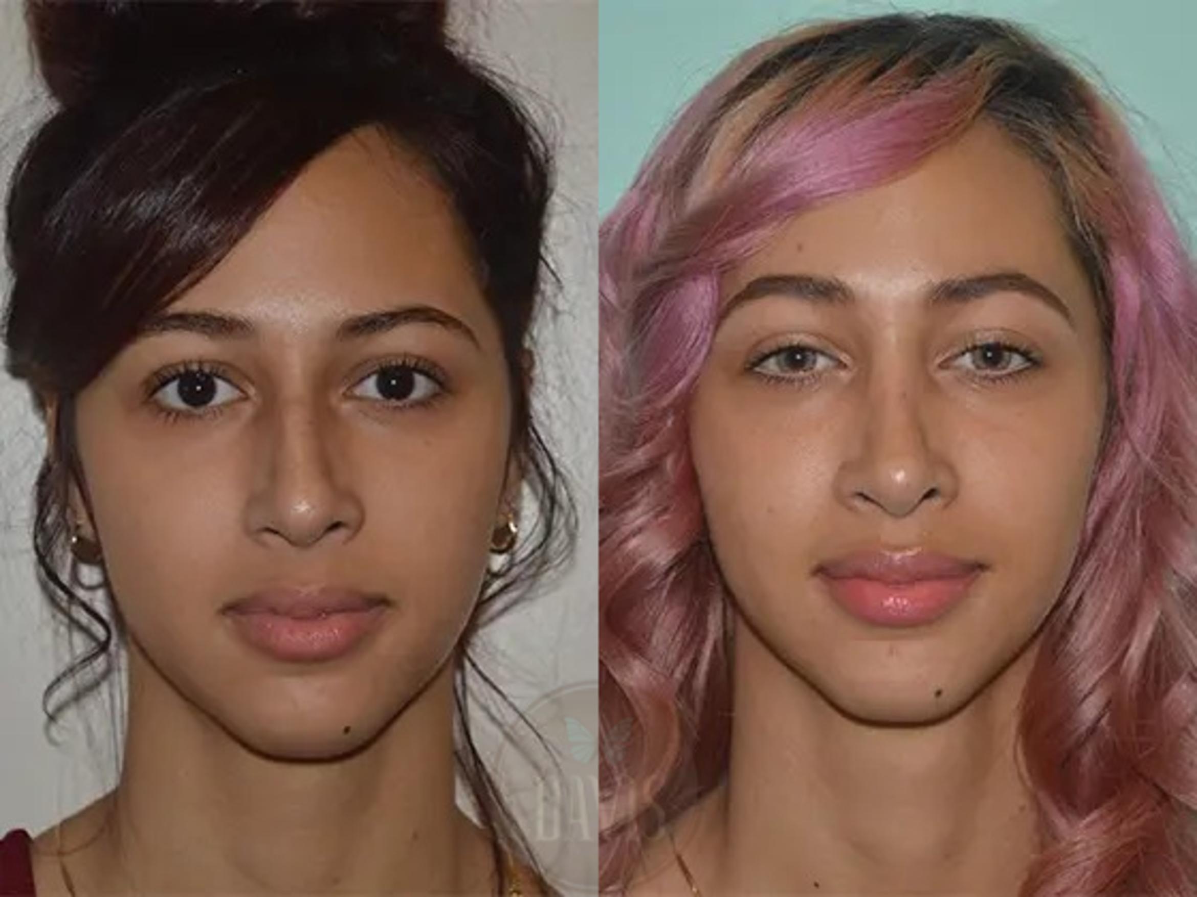 Before & After Female Rhinoplasty Case 1052 View 2 View in Tampa, FL