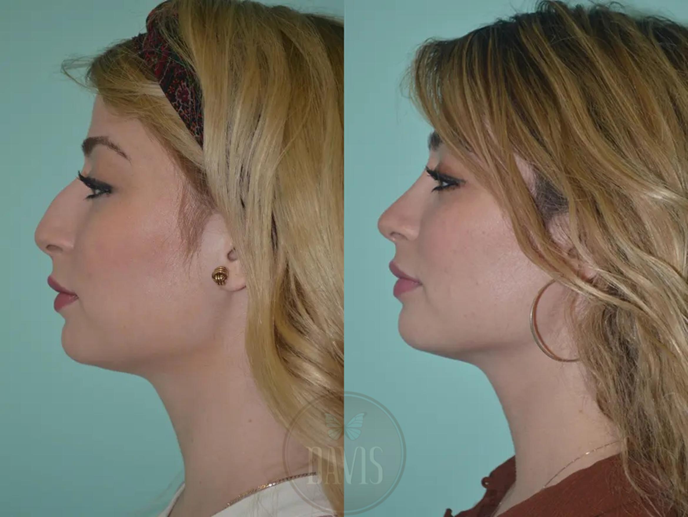 Before & After Female Rhinoplasty Case 1053 View 1 View in Tampa, FL