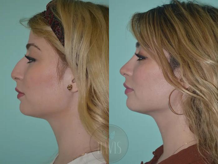 Before & After Female Rhinoplasty Case 1053 View 1 View in Tampa, FL
