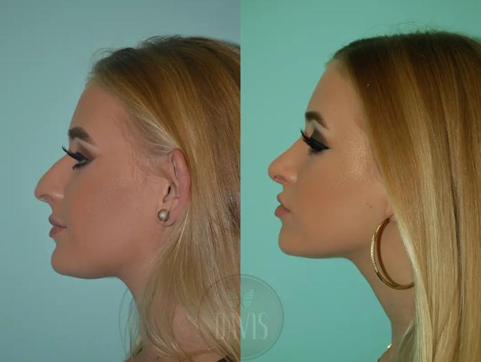 Before & After Female Rhinoplasty Case 1054 View 1 View in Tampa, FL