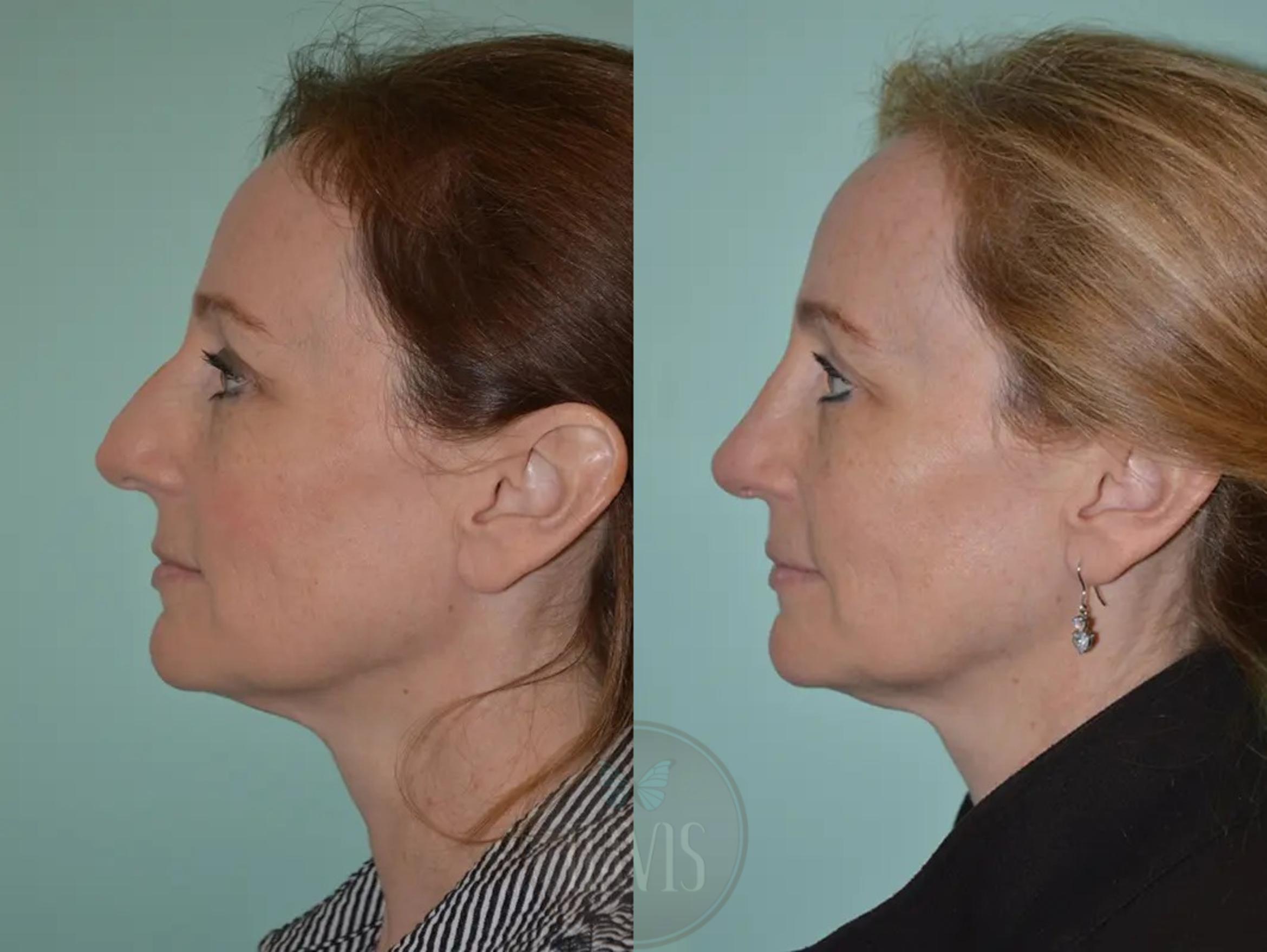 Before & After Female Rhinoplasty Case 1055 View 1 View in Tampa, FL