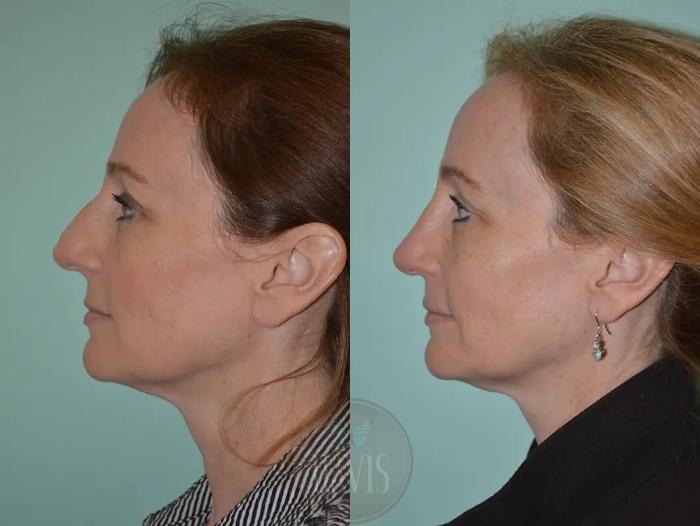 Before & After Female Rhinoplasty Case 1055 View 1 View in Tampa, FL