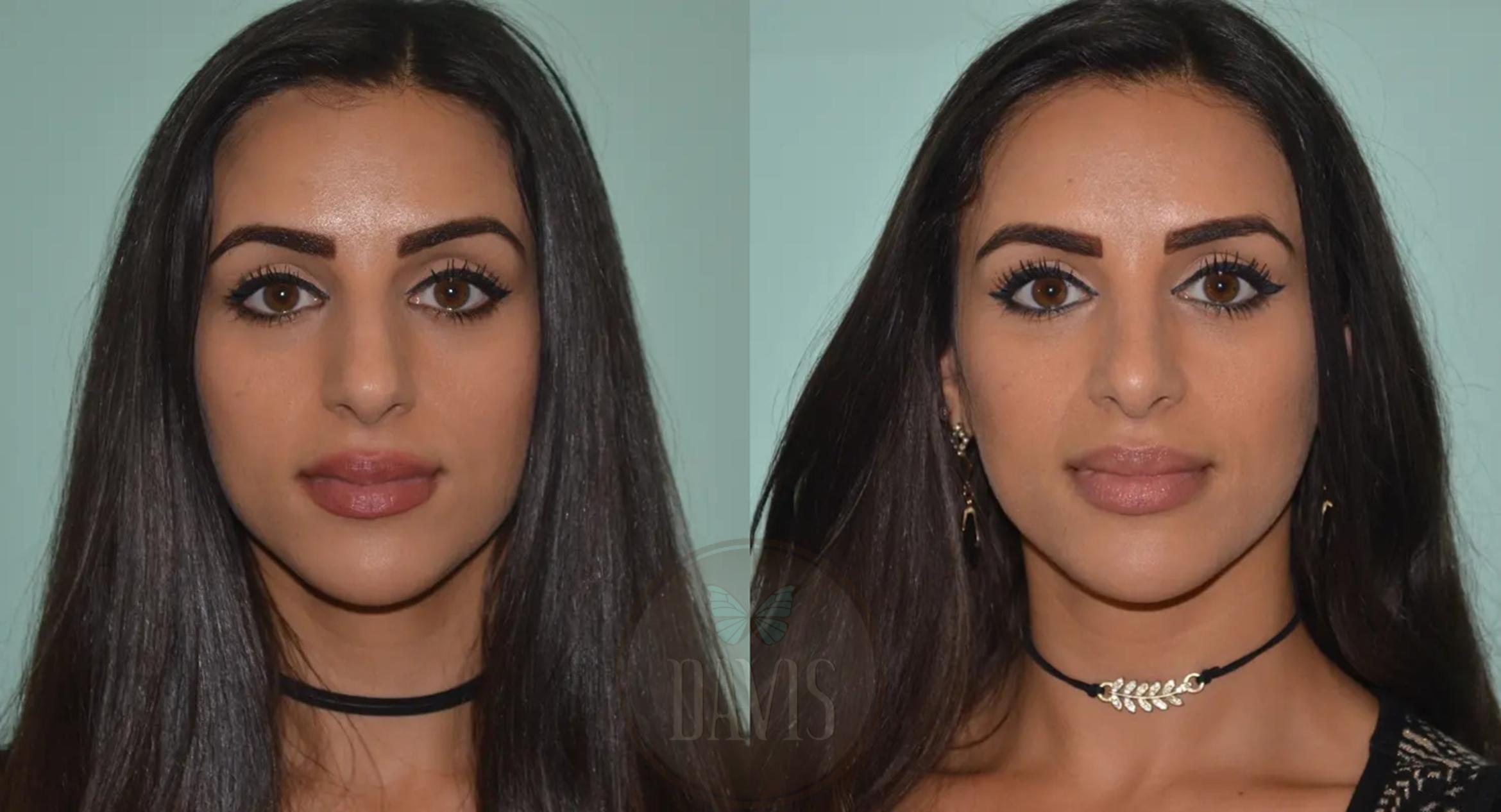 Before & After Female Rhinoplasty Case 1056 View 1 View in Tampa, FL