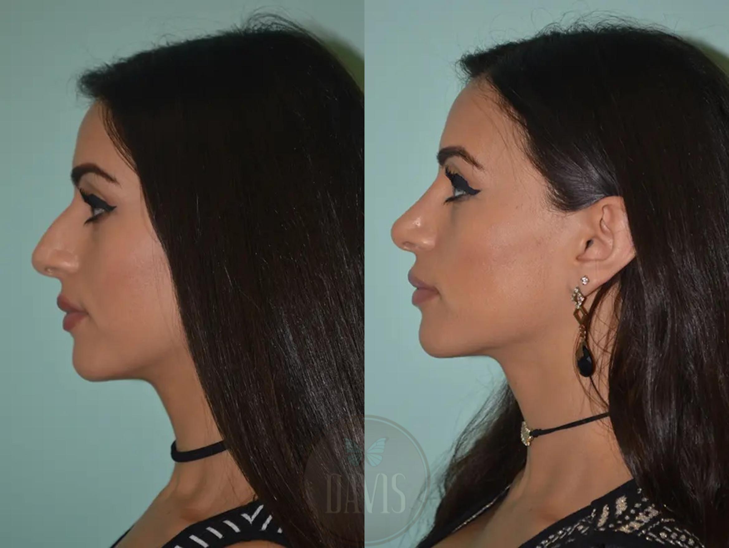Before & After Female Rhinoplasty Case 1056 View 2 View in Tampa, FL