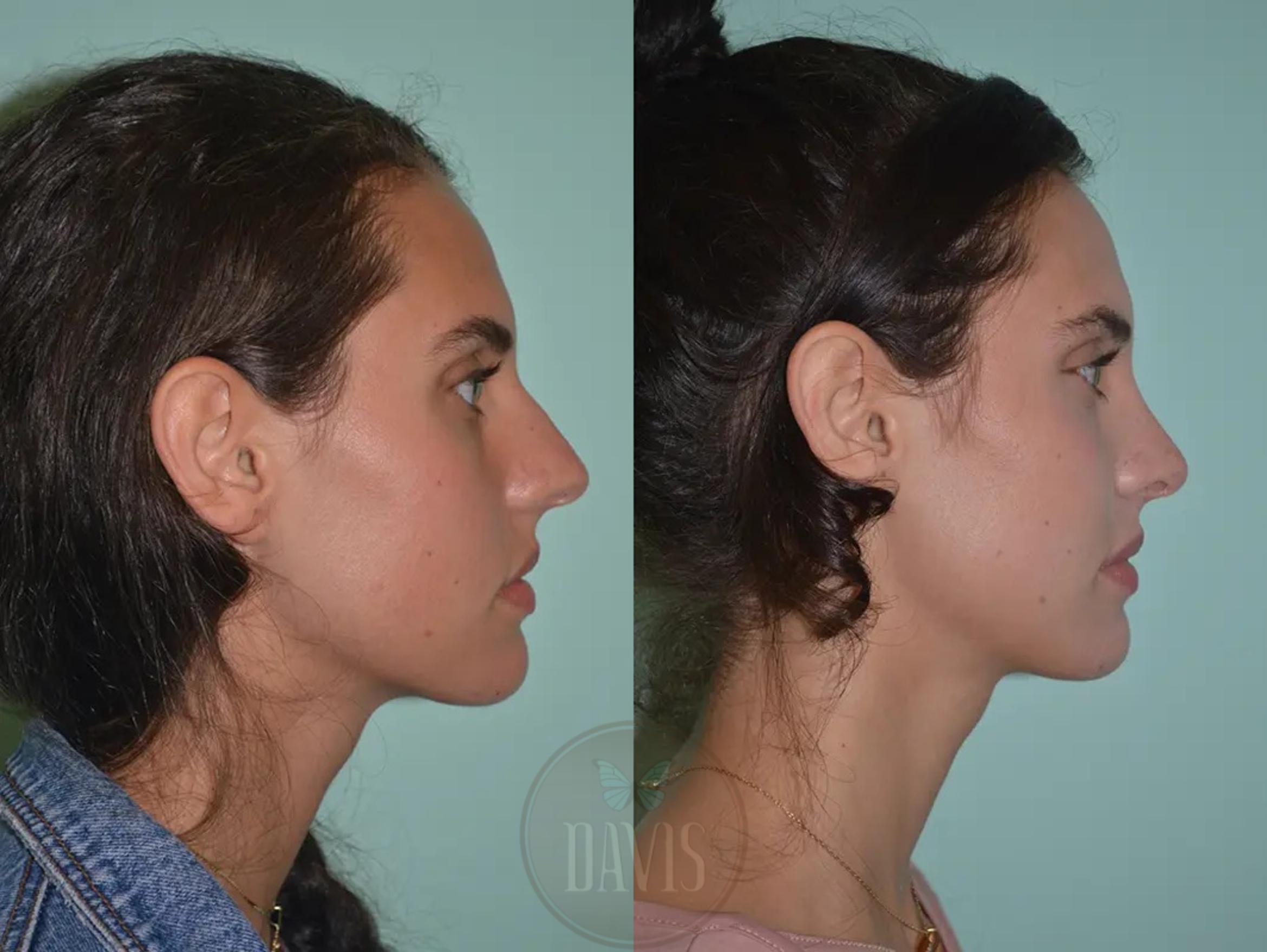 Before & After Female Rhinoplasty Case 1057 View 1 View in Tampa, FL