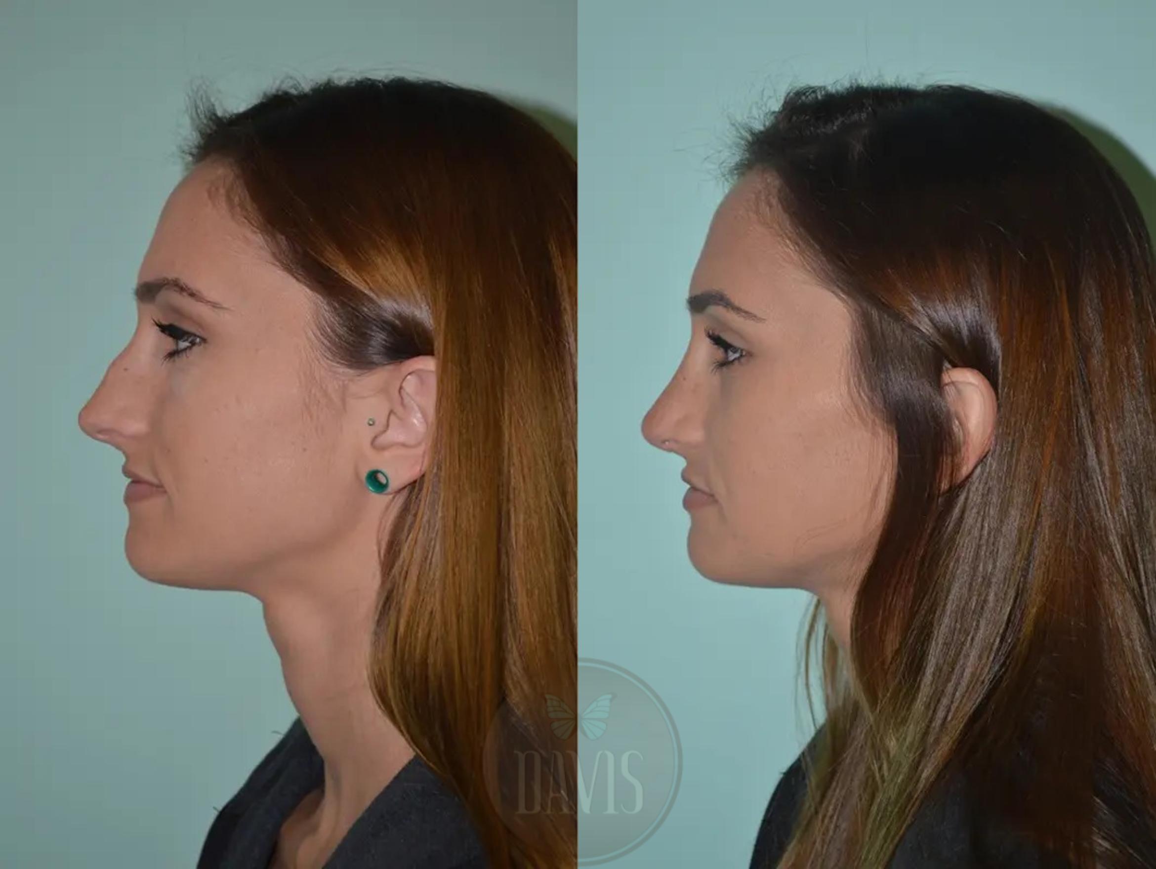 Before & After Female Rhinoplasty Case 1058 View 1 View in Tampa, FL