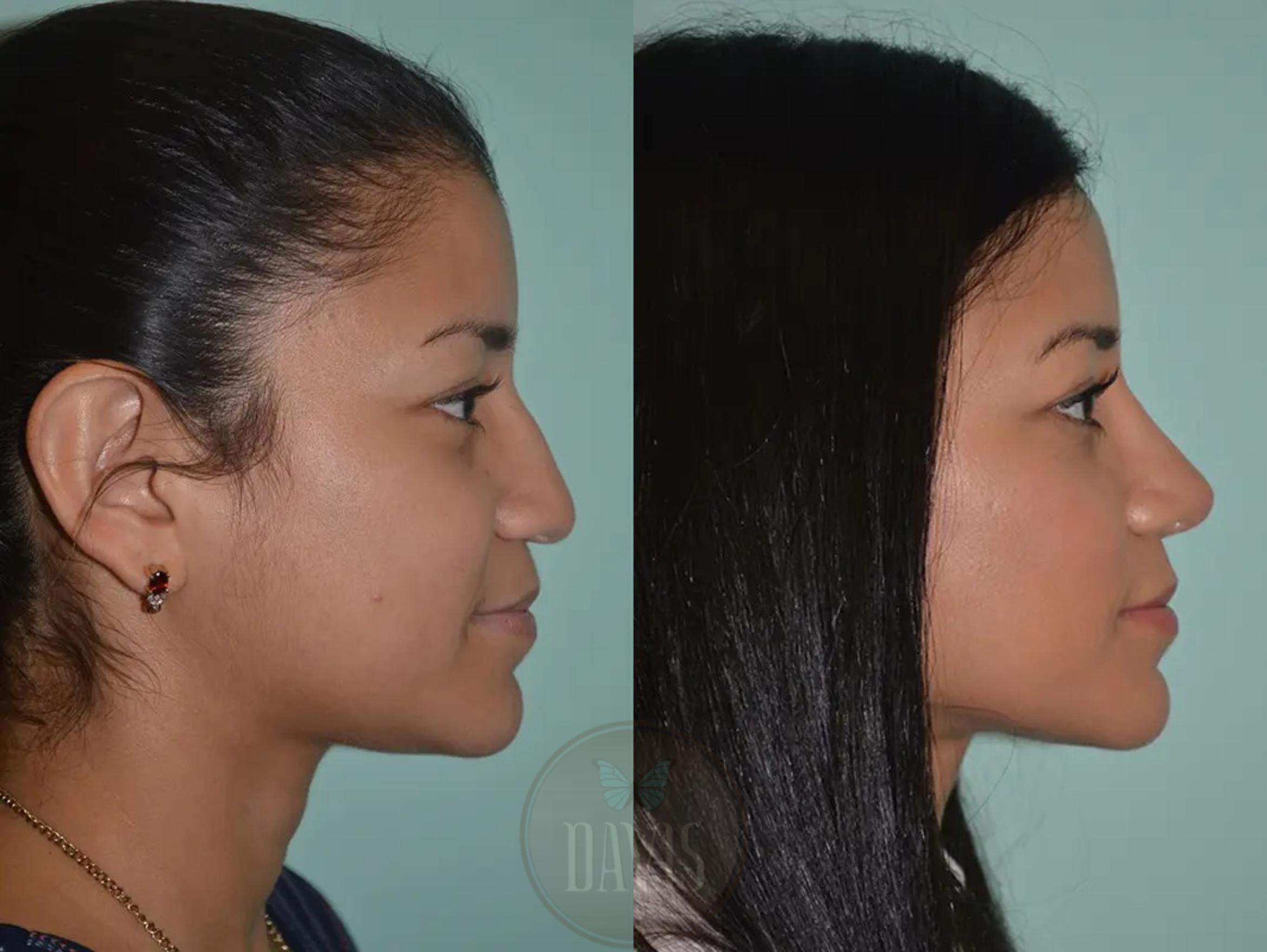 Before & After Female Rhinoplasty Case 1059 View 1 View in Tampa, FL