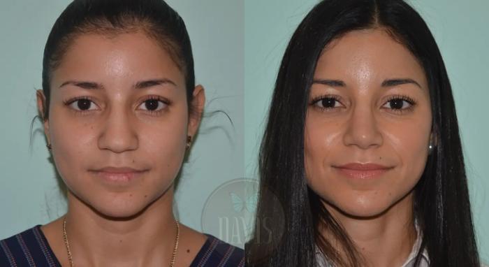 Before & After Female Rhinoplasty Case 1059 View 2 View in Tampa, FL