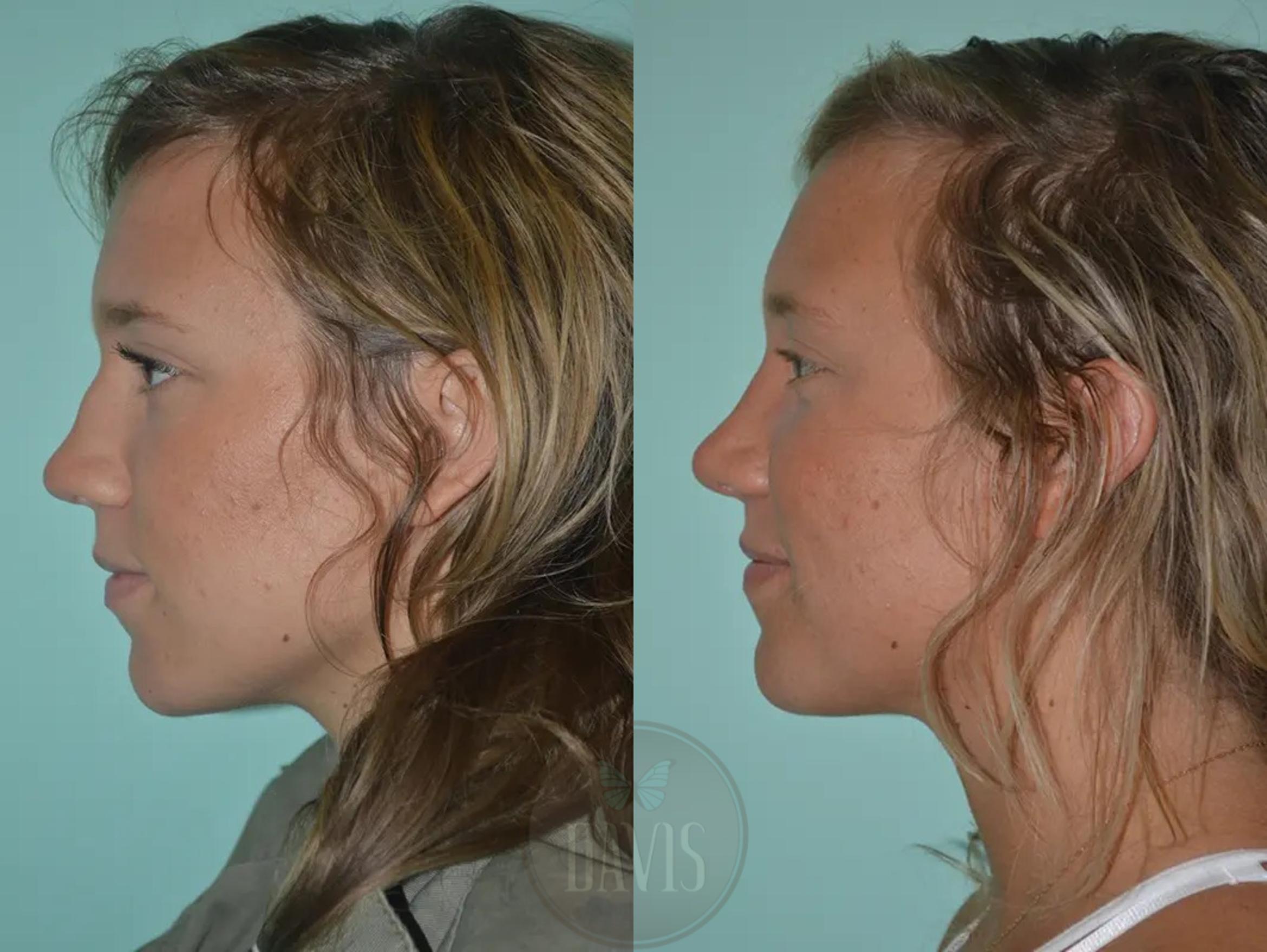 Before & After Female Rhinoplasty Case 1060 View 1 View in Tampa, FL