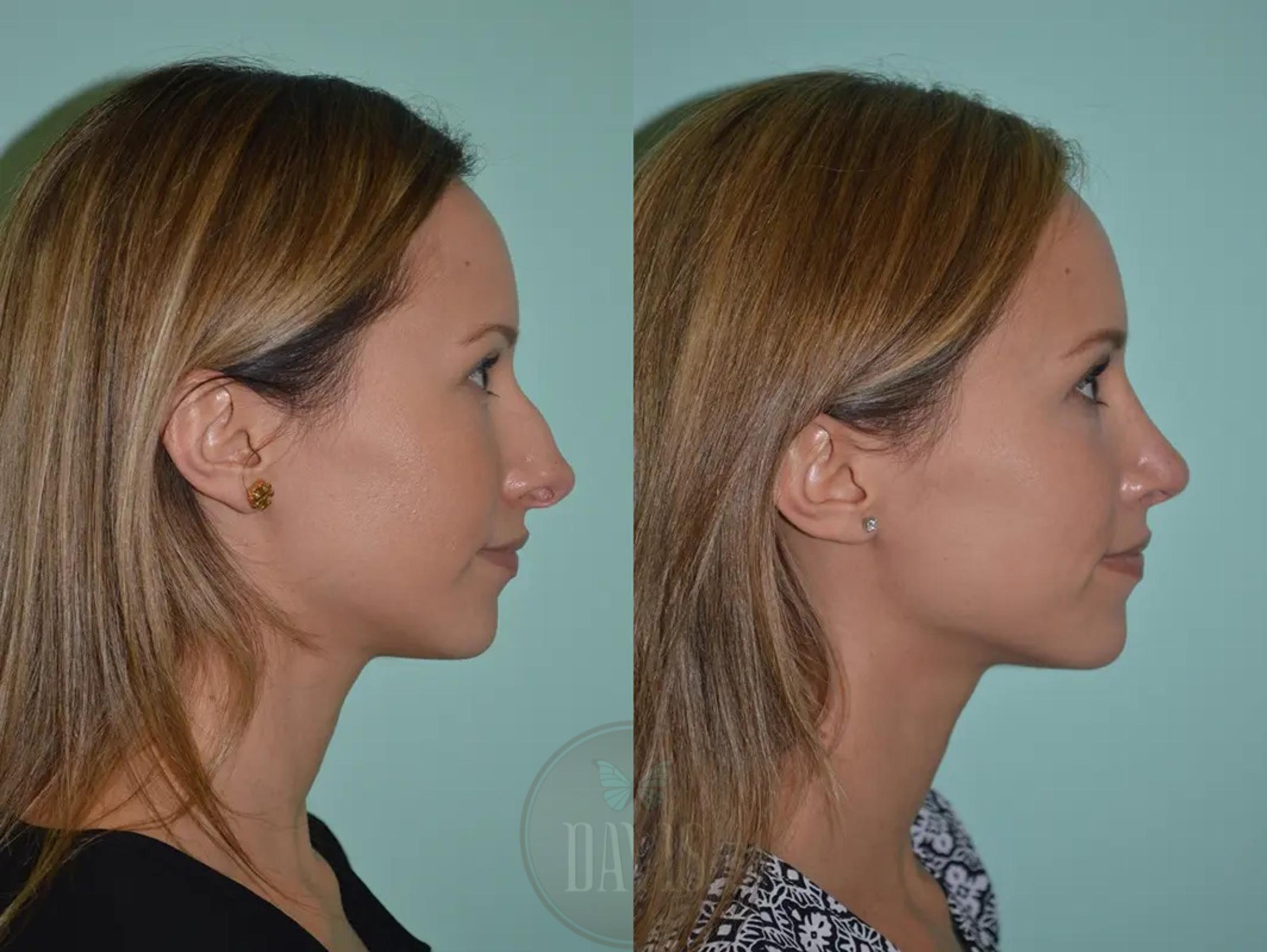 Before & After Female Rhinoplasty Case 1061 View 1 View in Tampa, FL