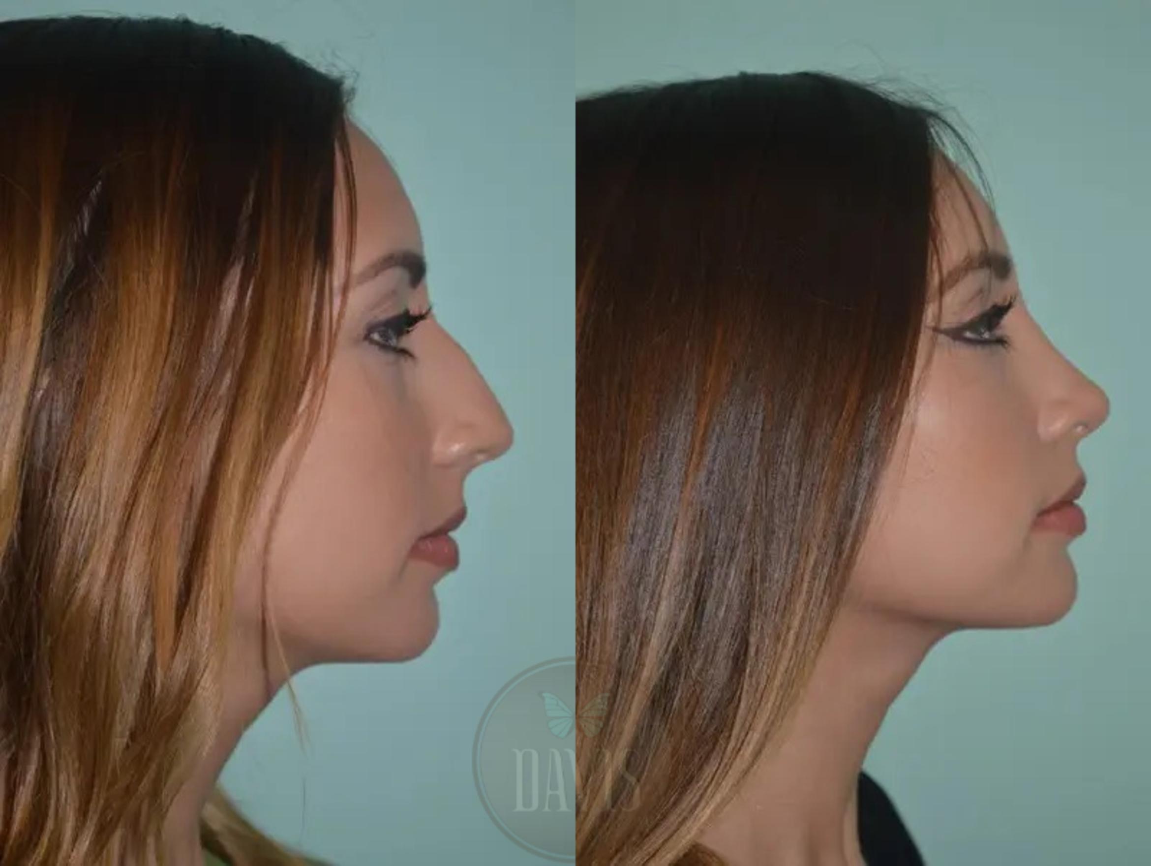 Before & After Female Rhinoplasty Case 1062 View 1 View in Tampa, FL