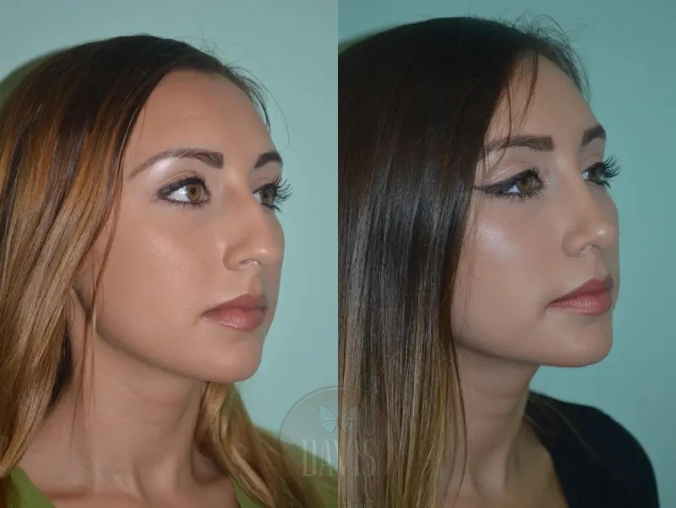 Before & After Female Rhinoplasty Case 1062 View 2 View in Tampa, FL