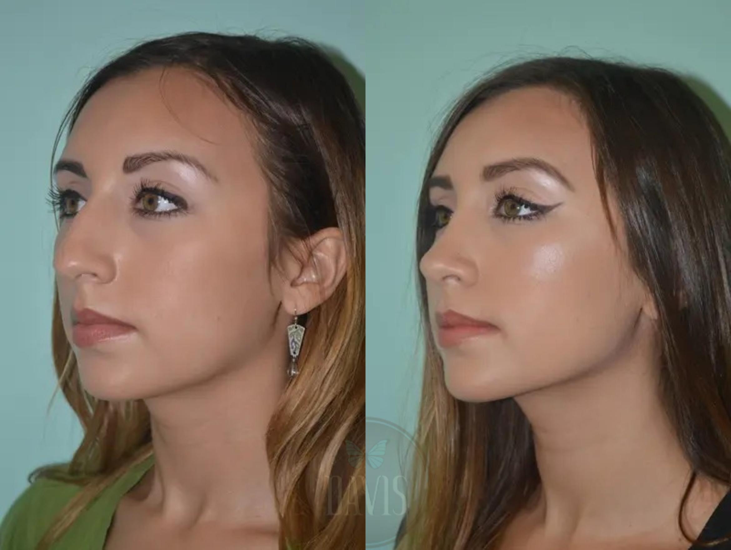 Before & After Female Rhinoplasty Case 1062 View 3 View in Tampa, FL