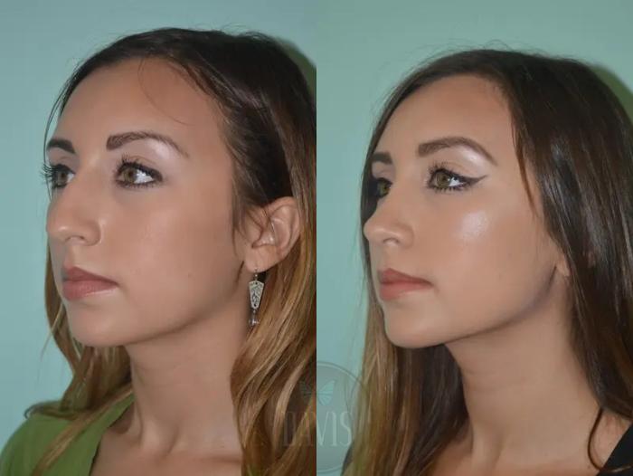 Before & After Female Rhinoplasty Case 1062 View 3 View in Tampa, FL