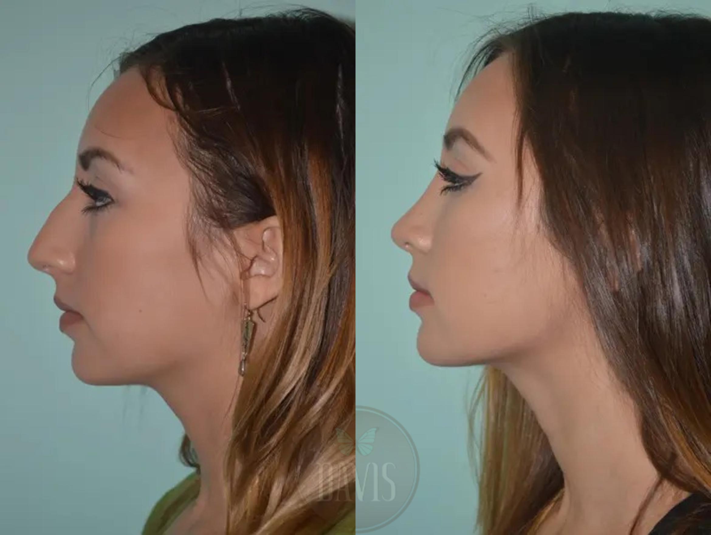 Before & After Female Rhinoplasty Case 1062 View 4 View in Tampa, FL