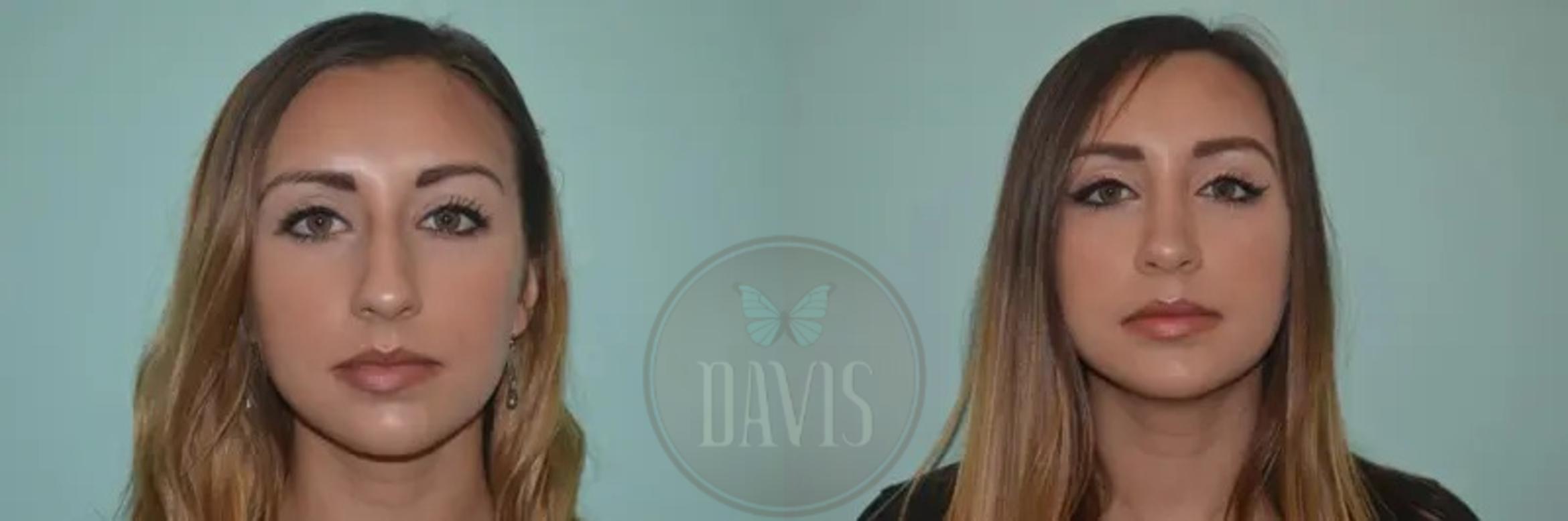 Before & After Female Rhinoplasty Case 1062 View 5 View in Tampa, FL