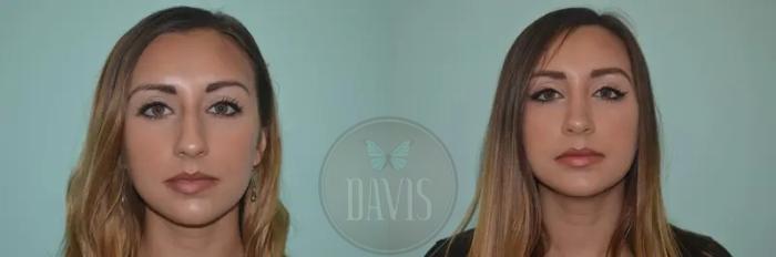 Before & After Female Rhinoplasty Case 1062 View 5 View in Tampa, FL